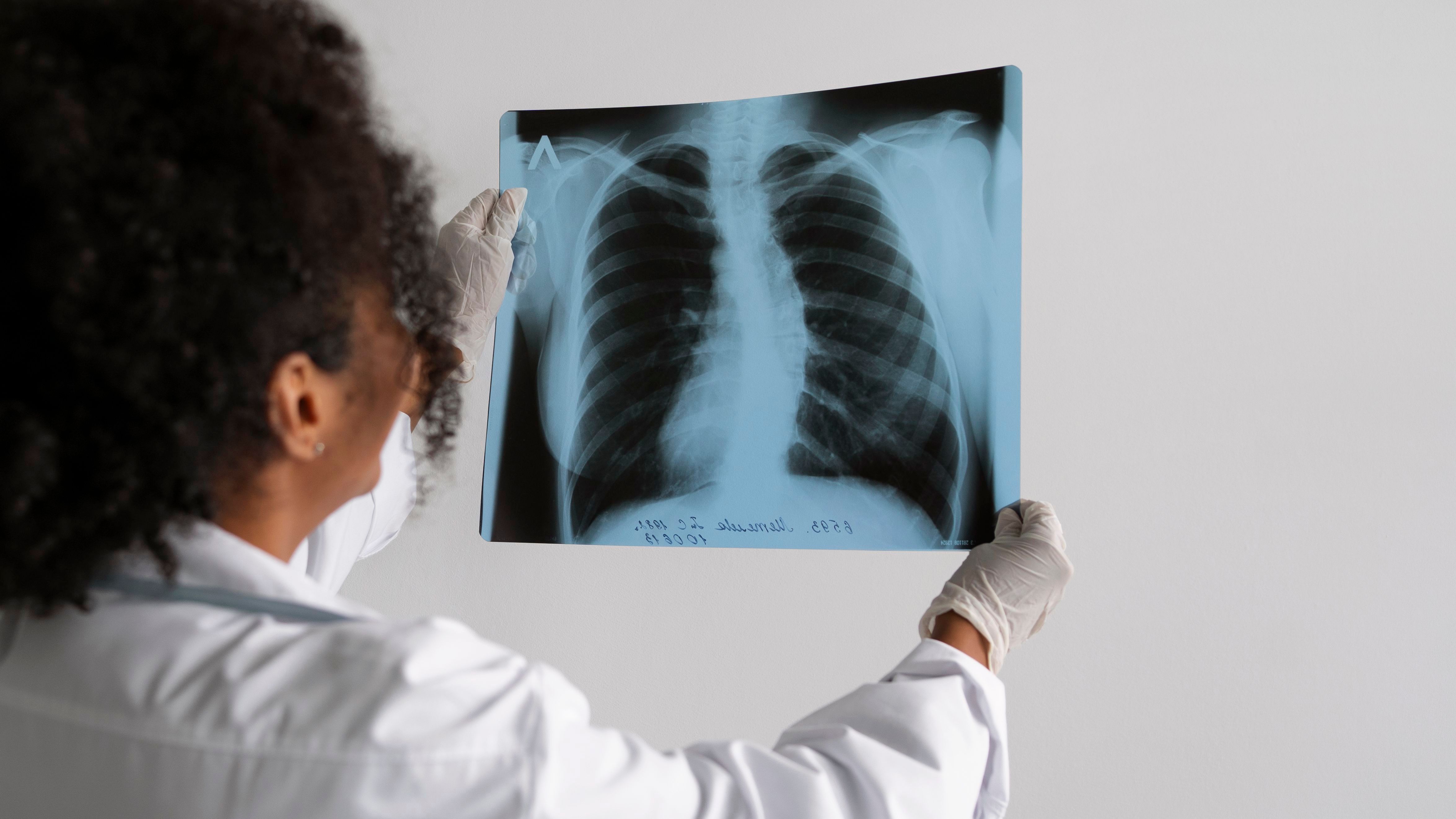 Un antes y un después contra el cáncer de pulmón
